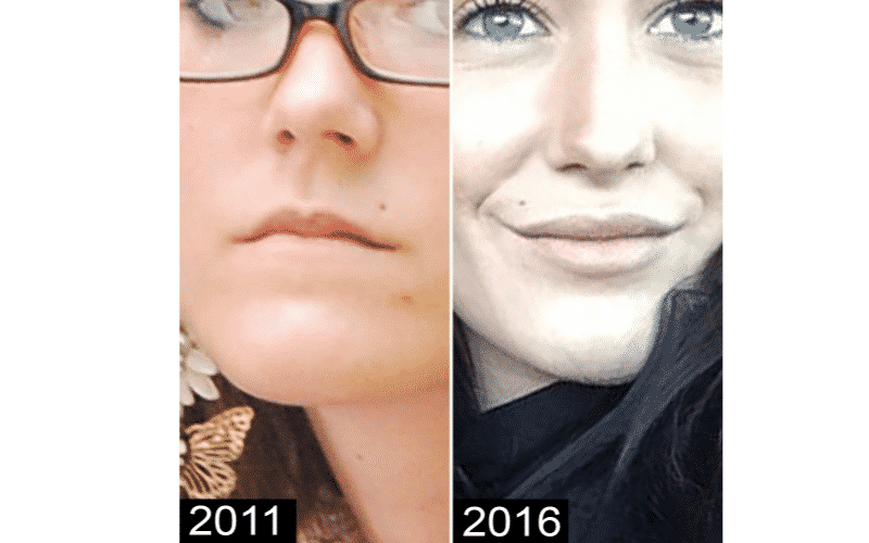 jenelle lip fillers