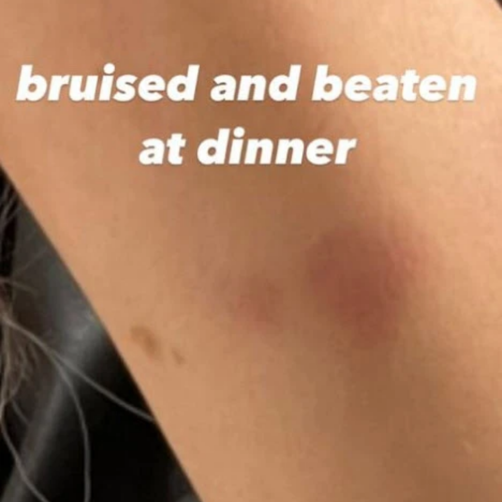 farrahs bruise